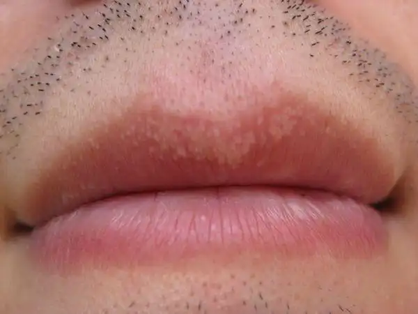 嘴唇起了白点点什么情况