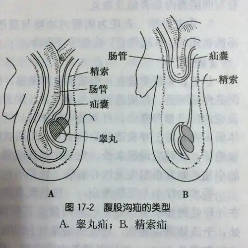 小儿腹股沟斜疝诊治的问与答