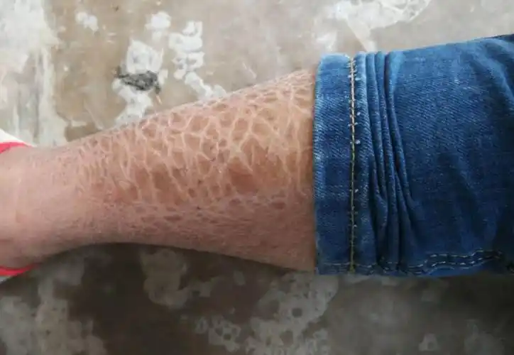 广西女子喜爱吃蛇肉,腿上长出蛇鳞,医院检查后惊慌失措