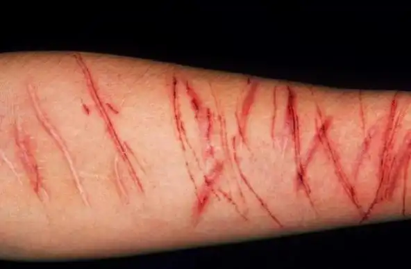 自残,是无声的求救信号