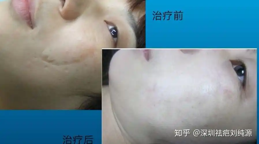 十几年的凹陷性疤痕能修复好吗