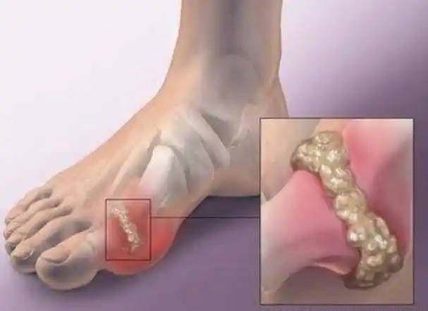 为何痛风者越来越多?是"豆制品"惹的祸?医生:这4物尽量少碰_尿酸_生活