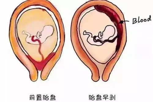 胎盘前置会出现哪些常见症状_漂亮女人街