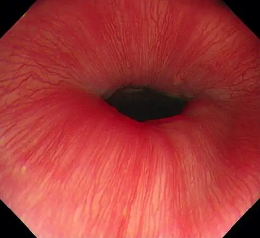 反酸,烧心,咳嗽?可能是反流性食管炎在作祟_湃客_澎湃新闻-the paper