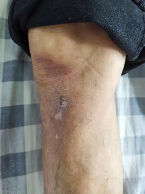 慢性骨髓炎讨论