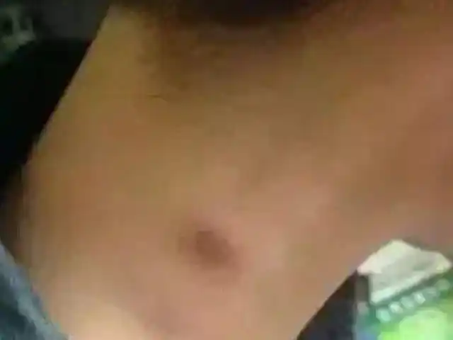 全国100多万艾滋病患者不管男女若脖子有这标志就要注意