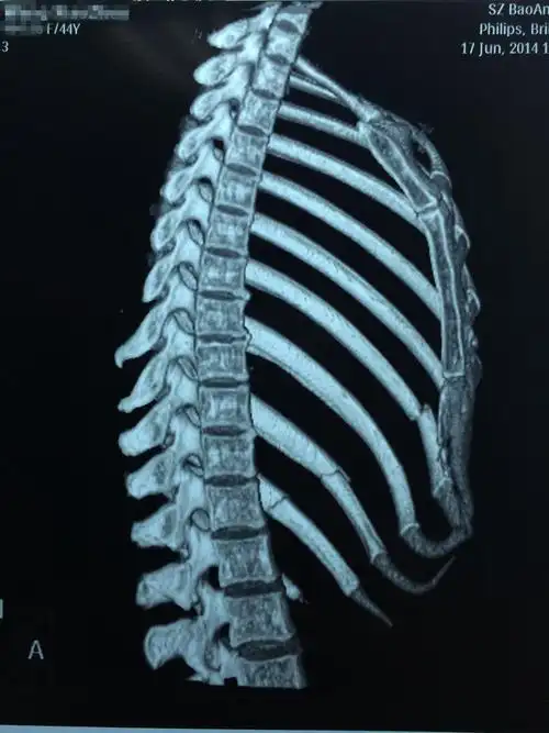 问:肋骨骨折断端重叠(详见ct报告单,图片)