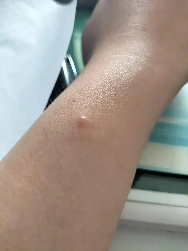 蜱虫.这就是采野茶的后果,不仅有今年的伤,还有去年的疤.一直 - 抖音