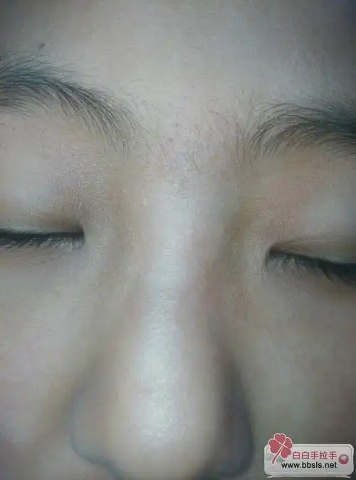 鼻子上有块皮肤发白是不是白白吗?