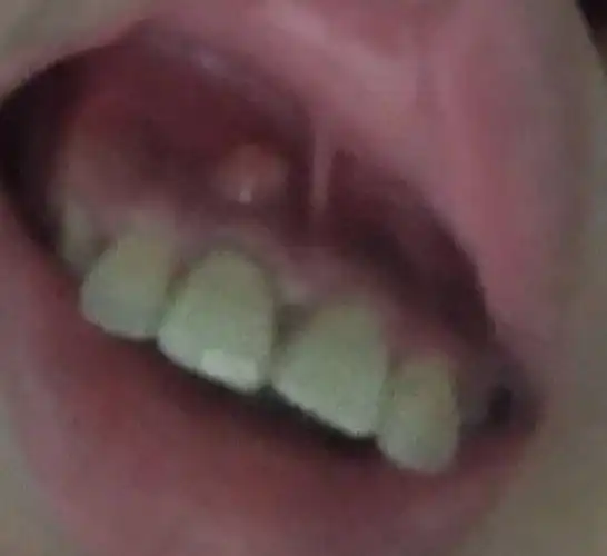 上牙龈做完上颚骨囊肿手术后1年起了个包 是怎么回事?