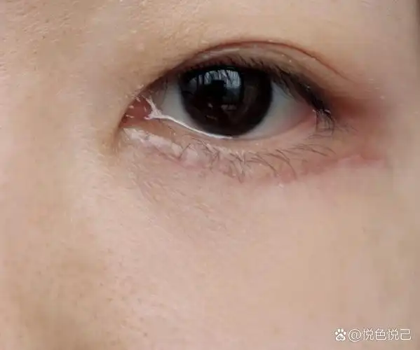 外切眼袋眶隔释放第17天