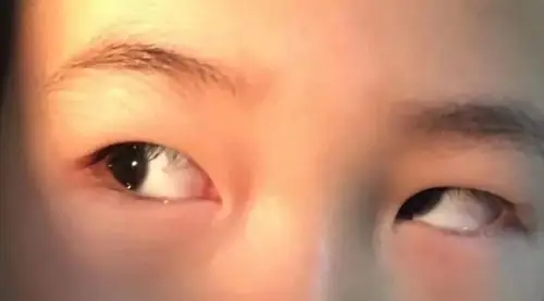 斜视随年龄增长自然会好不用治疗专家莫让斗鸡眼毁了孩子一生