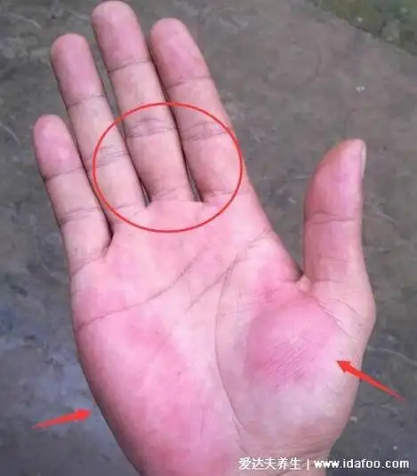 真实的肝掌图片高清图片,肝掌/蜘蛛痣可能是严重肝病的前兆