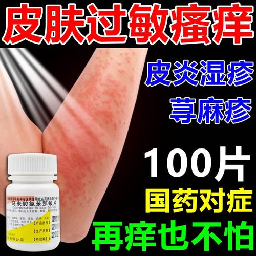 【jd药房直售】全身痒皮肤瘙痒吃什么药皮炎湿疹 荨麻疹专用药过敏