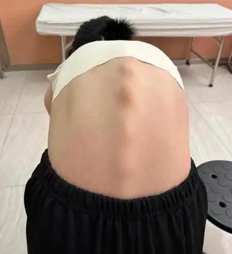 脊柱后凸有哪些症状应该怎样诊断和治疗