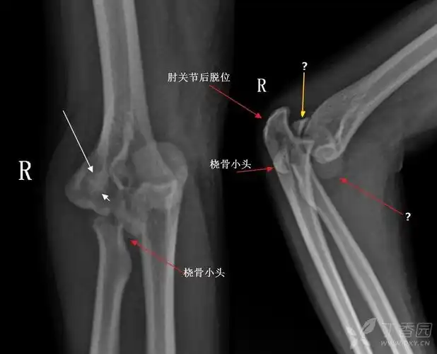 肱骨内,外髁及鹰