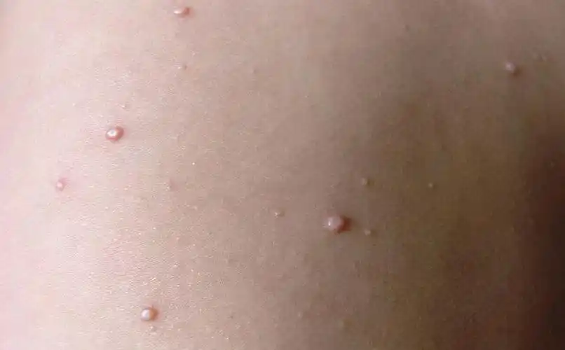 私处长肉疙瘩,一定是得性病了?