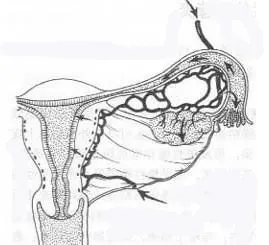 子宫内膜异位症的诊断方式