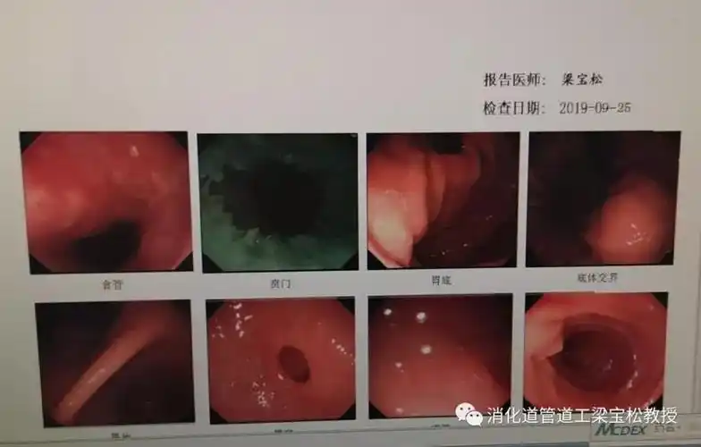 当麻醉达成之后,我操作胃镜轻柔准确地插入食管,按照标准的胃镜检查