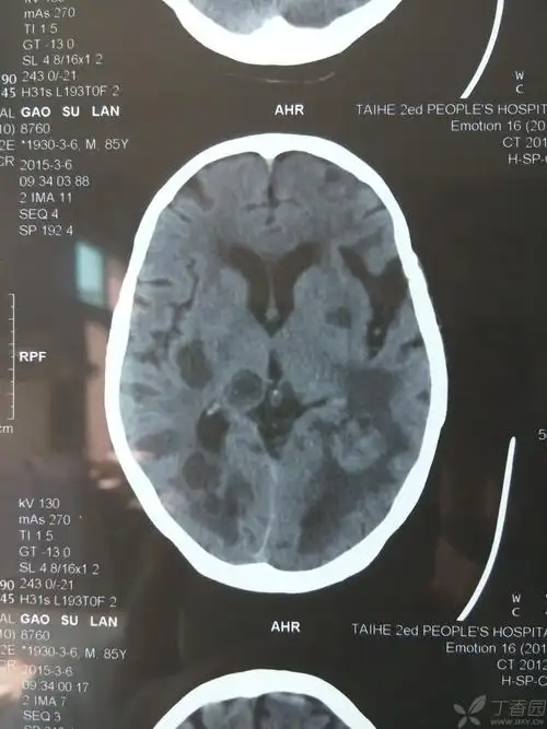 从形状看不像脑梗死,病人家属不愿再花钱查磁共振.