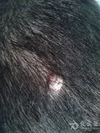 头皮上长一个疙瘩这是什么病怎么治疗