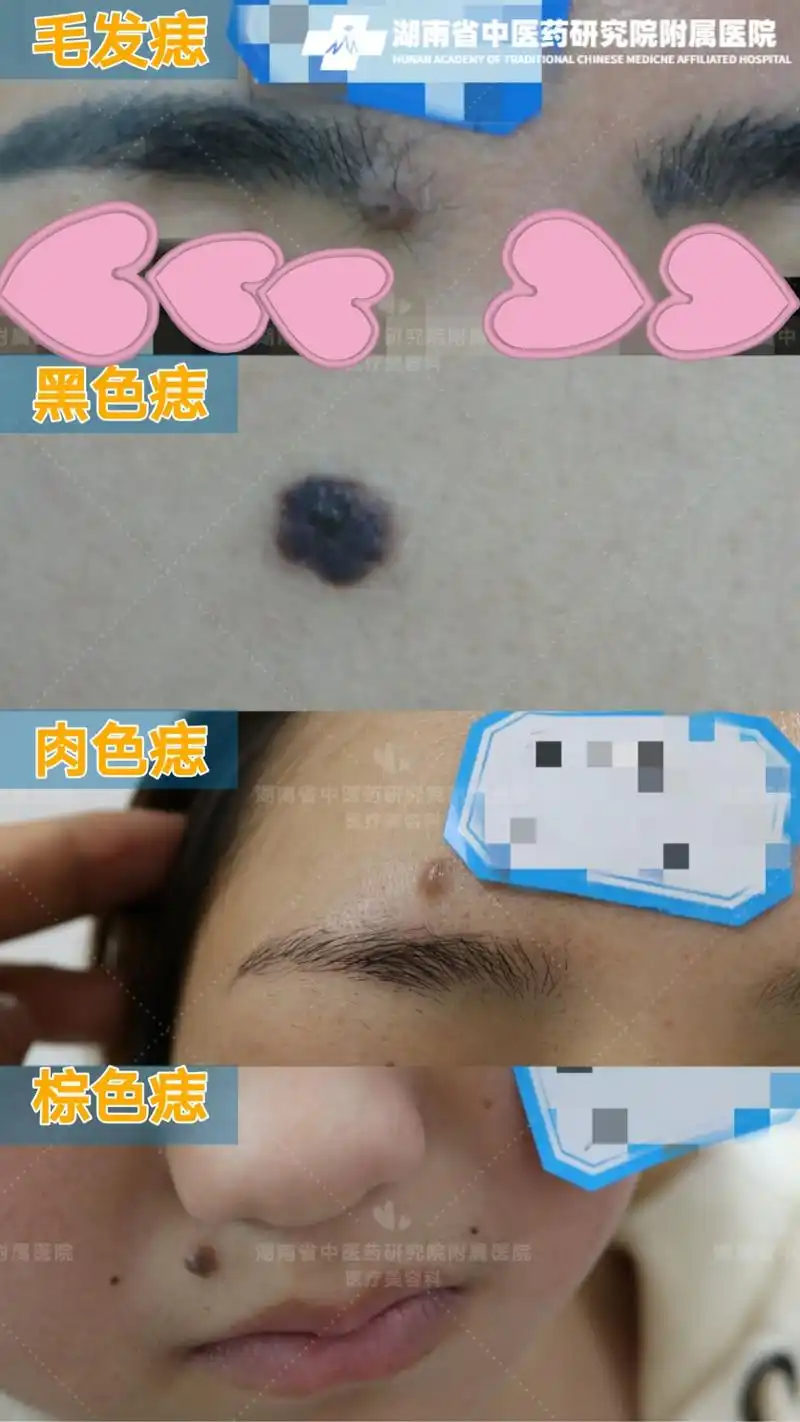 肉痣越来越大是怎么回事?【湖南省中医药研究院附属医院】