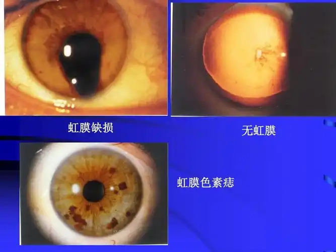 虹膜缺损 无虹膜 虹膜色素痣