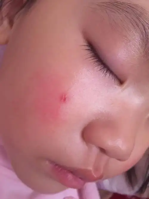 两岁宝宝脸被指甲抓伤,皮下组织是红色的,会不会留疤,可以涂维生素e吗