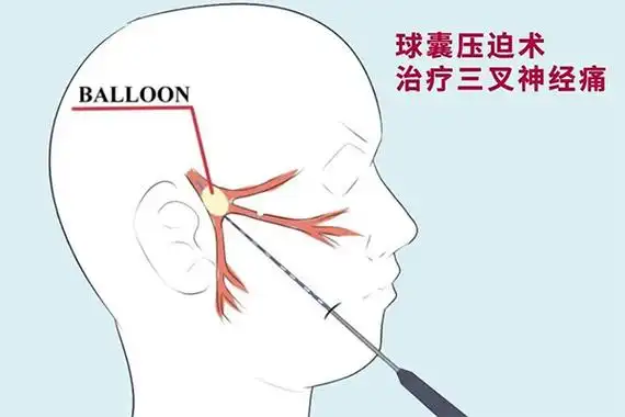 经皮穿刺三叉神经痛球囊压迫术解除患者八年痛苦折磨