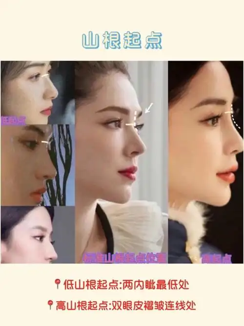 隆鼻分享之山根篇