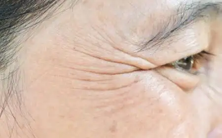 鱼尾纹可以用脂肪填充吗