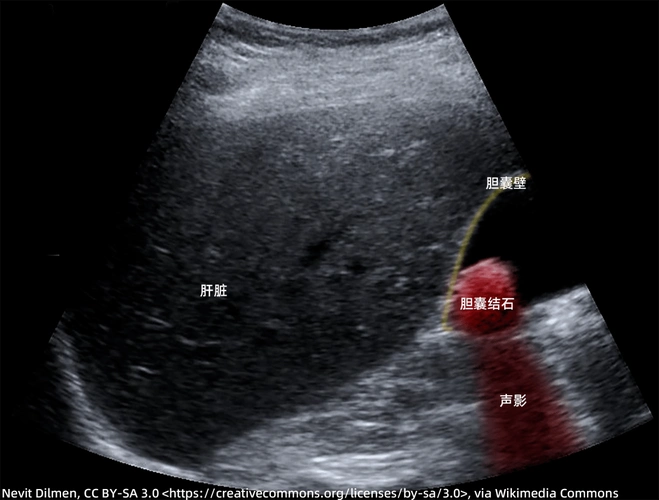 每日技能影像学超声之胆囊结石