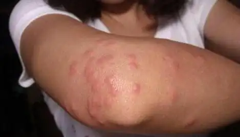 隐翅虫咬了的症状图片隐翅虫图片怎么预防