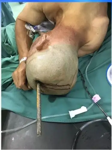 [案例解读]西京医院成功救治一名钢筋颅脑贯穿伤患者