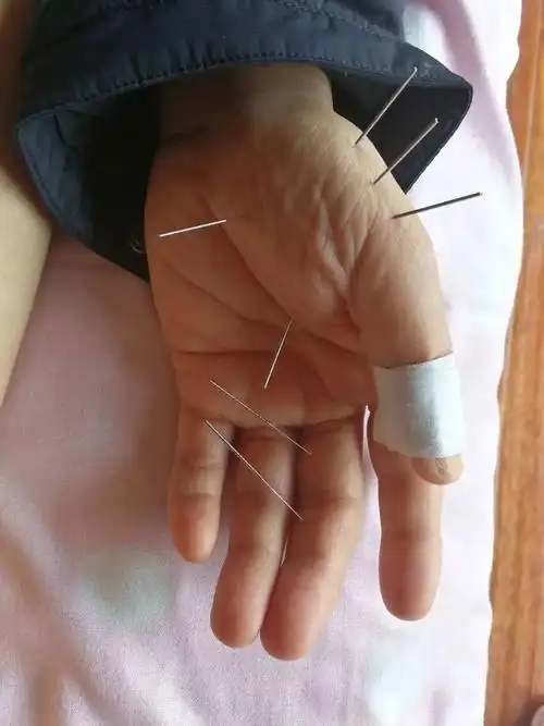 董氏针灸:真人扎针彩图鉴赏