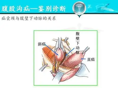 人体腹股沟疝的分型,诊疗