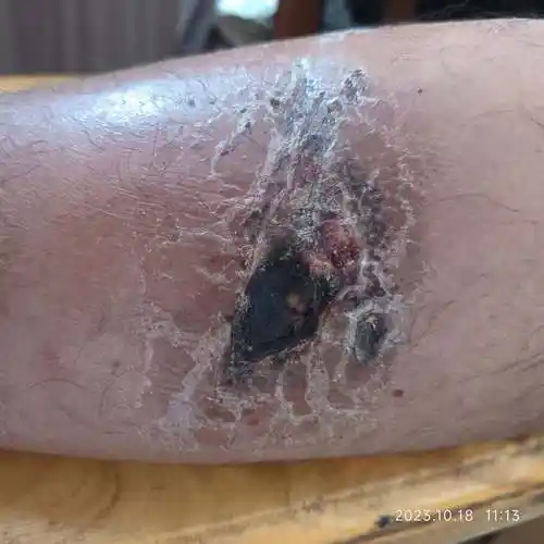 伤口皮肤愈合不良假性结痂中医有云化腐生肌祛腐生肌