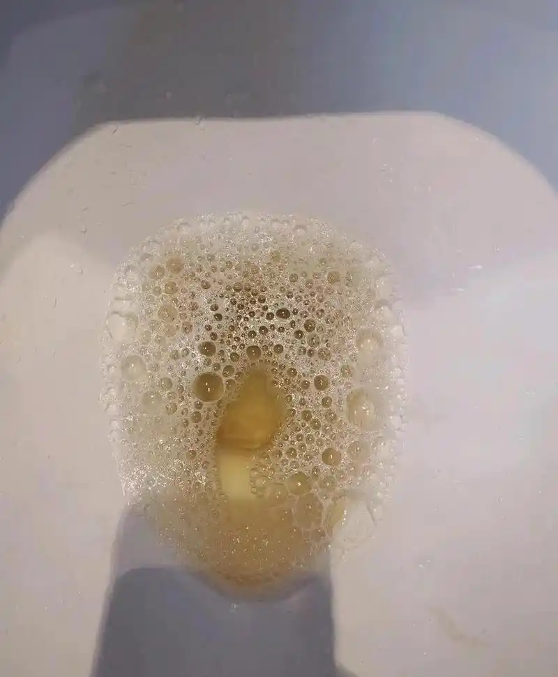 张女士近4个月来,经常发现尿中泡沫丰富,后经尿常规化验,发现蛋白4 .