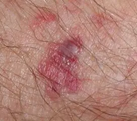 向医生提问葡萄球菌感染别名:发病部位:并发疾病热门问答金葡萄球菌