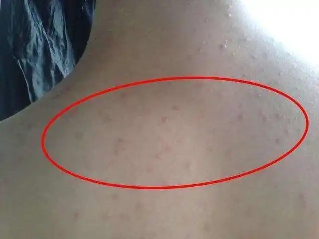 春天来了前后背老长斑点怎么办