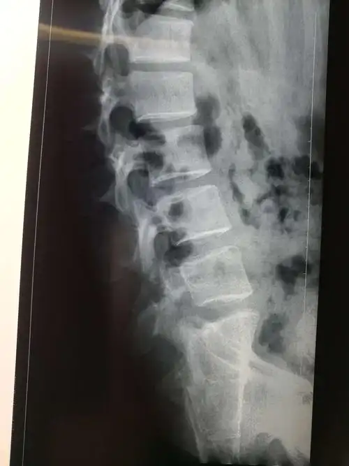 朱根营 男 31 腰5椎体峡部裂