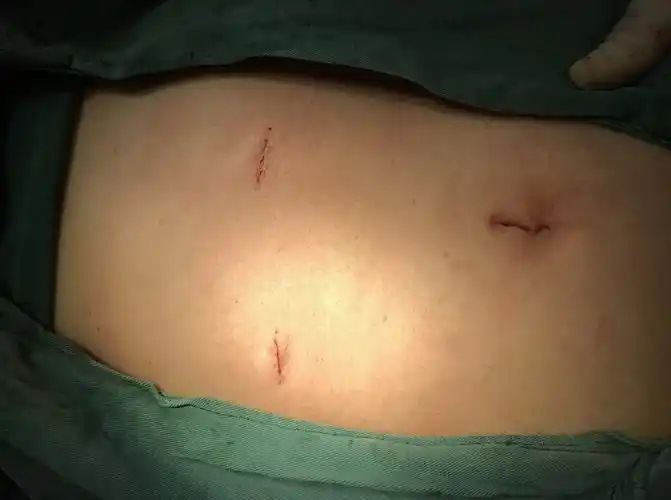 腹腔镜胆囊切除术(lc-术者:孙兴) - 好大夫在线