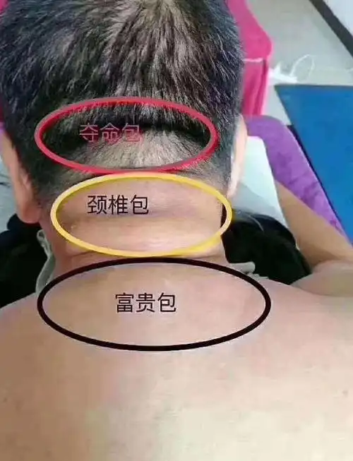导语:从医学角度来看,富贵包其实是由颈椎管狭窄症引起的,而不是单纯