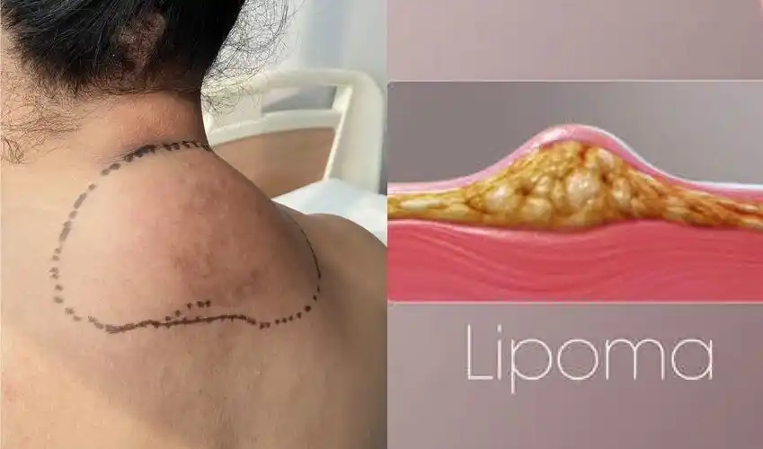 脂肪瘤的10大成因和治疗 - 孕育宝典-试管之家