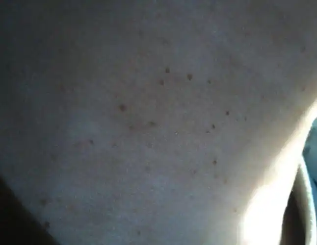 脖子初期寻常疣图片