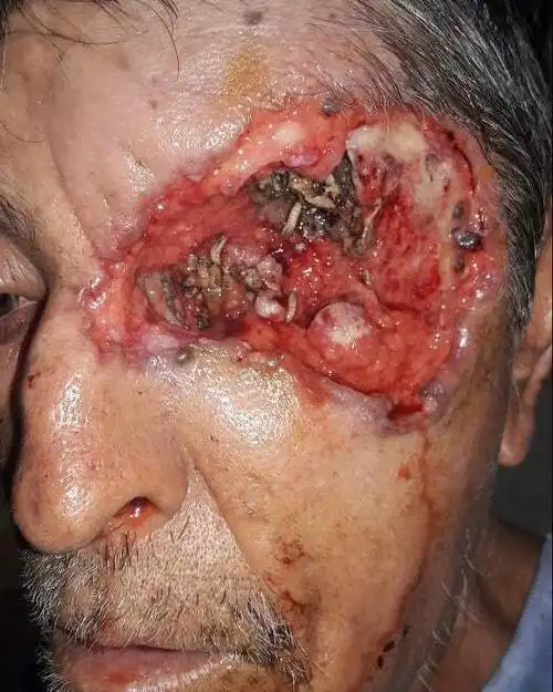 【虫子怎么会进眼睛】