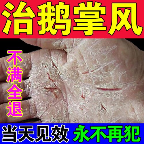 本草居的优惠券大全—鹅掌风药膏治疗手裂的药膏干裂脱皮鹅掌风真菌