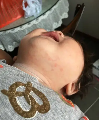 幼儿急疹