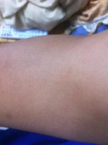 我手臂上有很多白色的圆点密密麻麻的.