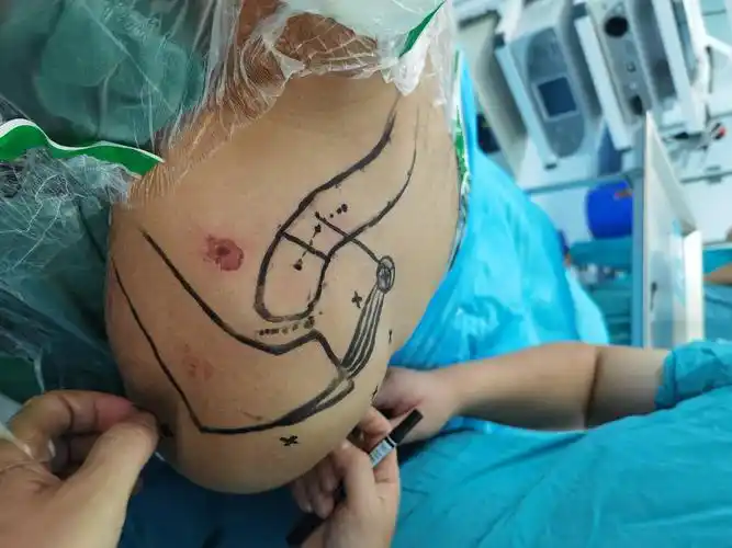 新鲜肩锁关节脱位关节镜下复位内固定术 - 好大夫在线